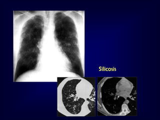 Silicosis

 