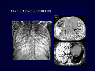 Alveolar microlithiasis

 