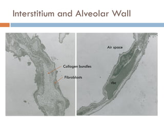 Interstitial lung disease | PDF