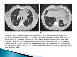Interstitial lung disease; Basic Understanding and approach | PPTX