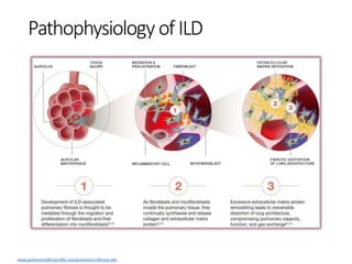 Interstitial Lung Disease.pptx