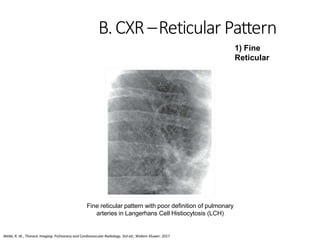 Interstitial Lung Disease.pptx