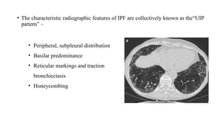 Ipf Radiographic Clinical approach of intersitial lung disease | PPTX