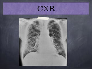 CXR
 