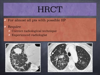HRCT
For almost all pts with possible IIP

Require
Correct radiological technique
Experienced radiologist
 