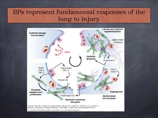 IIPs represent fundamental responses of the
lung to injury
 