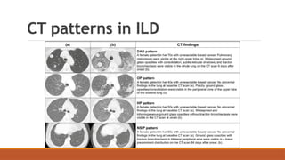 Ild Rads Algorithm Ct CLINICAL APPROACH TO INTERSTITIAL LUNG DISEASES | PPTX