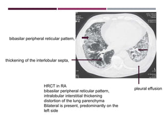 Interstitial Lung Diseases [ILD] Approach to Management | PPTX