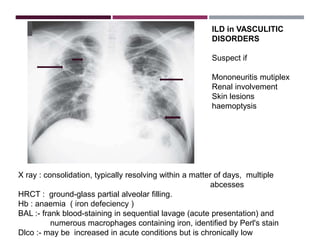 Interstitial Lung Diseases [ILD] Approach to Management | PPTX