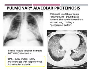 Interstitial Lung Diseases [ILD] Approach to Management | PPTX