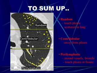 TO SUM UP..
• Random
– touch pleura
– scattered in lung
• Centrilobular
–away from pleura
• Perilymphatic
– around vessels, bronchi
– touch pleura or fissure
 