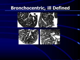 Bronchocentric, ill Defined
 