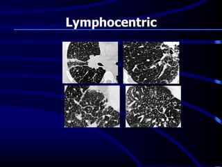 Lymphocentric
 