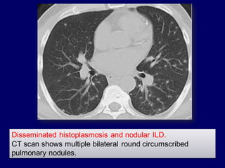 Disseminated histoplasmosis and nodular ILD.
CT scan shows multiple bilateral round circumscribed
pulmonary nodules.
 