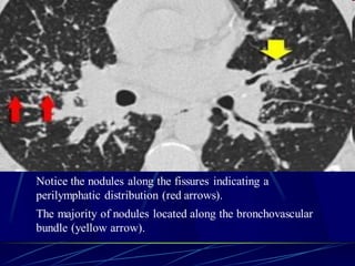 Notice the nodules along the fissures indicating a
perilymphatic distribution (red arrows).
The majority of nodules located along the bronchovascular
bundle (yellow arrow).
 