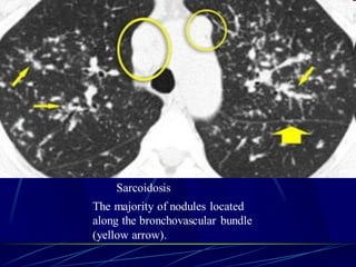 Sarcoidosis
The majority of nodules located
along the bronchovascular bundle
(yellow arrow).
 