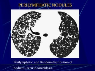 PERILYMPHATIC NODULES
Perilymphatic and Random distribution of
nodules , seen in sarcoidosis.
 