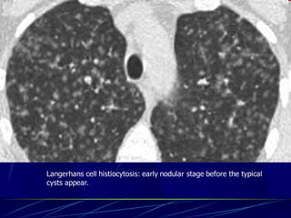 Langerhans cell histiocytosis: early nodular stage before the typical
cysts appear.
 