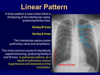 Linear Pattern
A linear pattern is seen when there is
thickening of the interlobular septa,
producing Kerley lines.
Kerley B lines
KerleyA lines
The interlobular septa contain
pulmonary veins and lymphatics.
The most common cause of interlobular
septal thickening, producing Kerley A
and B lines, is pulmonary edema, as a
result of pulmonary venous
hypertension and distension of the
lymphatics.
Kerley B lines
Kerley A lines
 