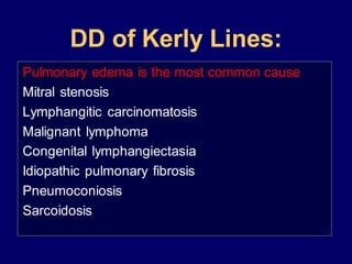 DD of Kerly Lines:
Pulmonary edema is the most common cause
Mitral stenosis
Lymphangitic carcinomatosis
Malignant lymphoma
Congenital lymphangiectasia
Idiopathic pulmonary fibrosis
Pneumoconiosis
Sarcoidosis
 