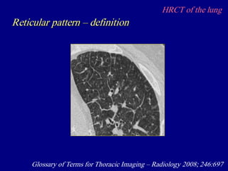 HRCT of the lung
Reticular pattern – definition
Glossary of Terms for Thoracic Imaging – Radiology 2008; 246:697
 