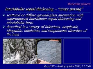 Reticular pattern
Interlobular septal thickening – “crazy paving”
 scattered or diffuse ground-glass attenuation with
superimposed interlobular septal thickening and
intralobular lines
 described in a variety of infectious, neoplastic,
idiopathic, inhalation, and sanguineous disorders of
the lung
Rossi SE – Radiographics 2003; 23:1509
 