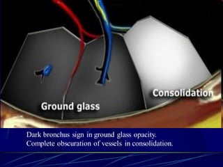 Dark bronchus sign in ground glass opacity.
Complete obscuration of vessels in consolidation.
 