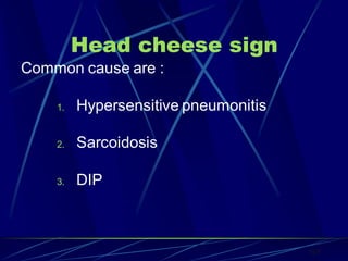 Head cheese sign
Common cause are :
1. Hypersensitive pneumonitis
2. Sarcoidosis
3. DIP
163
 