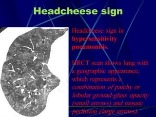 Headcheese sign
Headcheese sign in
hypersensitivity
pneumonitis.
HRCT scan shows lung with
a geographic appearance,
which represents a
combination of patchy or
lobular ground-glass opacity
(small arrows) and mosaic
perfusion (large arrows).
 