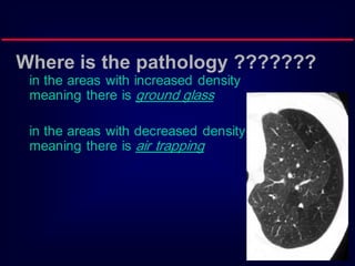 Where is the pathology ???????
in the areas with increased density
meaning there is ground glass
in the areas with decreased density
meaning there is air trapping
 