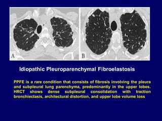 Idiopathic Pleuroparenchymal Fibroelastosis
PPFE is a rare condition that consists of fibrosis involving the pleura
and subpleural lung parenchyma, predominantly in the upper lobes.
HRCT shows dense subpleural consolidation with traction
bronchiectasis, architectural distortion, and upper lobe volume loss
 