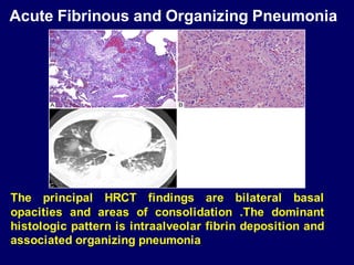 The principal HRCT findings are bilateral basal
opacities and areas of consolidation .The dominant
histologic pattern is intraalveolar fibrin deposition and
associated organizing pneumonia
Acute Fibrinous and Organizing Pneumonia
 