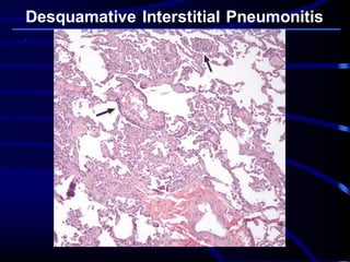 Desquamative Interstitial Pneumonitis
 