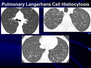 Pulmonary Langerhans Cell Histiocytosis
 