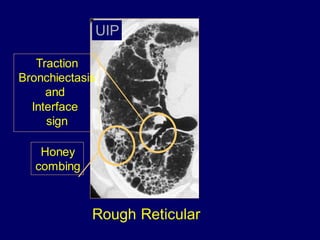 Rough Reticular
Traction
Bronchiectasis
and
Interface
sign
Honey
combing
UIP
 