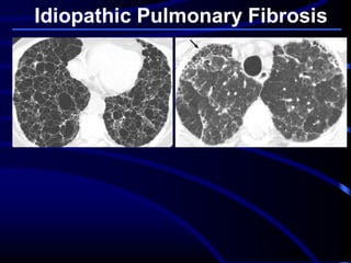 Idiopathic Pulmonary Fibrosis
 