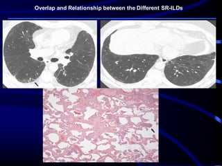 Overlap and Relationship between the Different SR-ILDs
 