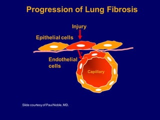 Injury
Epithelial cells
Slide courtesyof PaulNoble,MD.
Progression of Lung Fibrosis
Capillary
Endothelial
cells
?
 
