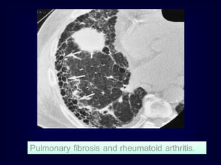 Pulmonary fibrosis and rheumatoid arthritis.
 