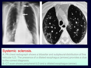 Systemic sclerosis.
A: PA chest radiograph shows a bibasilar and subpleural distribution of fine
reticular ILD. The presence of a dilated esophagus (arrows) provides a clue
to the correct diagnosis.
B: CT scan shows peripheral ILD and a dilated esophagus (arrow).
 