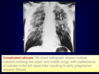 Complicated silicosis. PA chest radiograph shows multiple
nodules involving the upper and middle lungs, with coalescence
of nodules in the left upper lobe resulting in early progressive
massive fibrosis
 