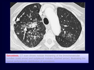 Sarcoidosis. CT scan shows nodular thickening of the bronchovascular
bundles (solid arrow) and subpleural nodules (dashed arrow), illustrating the
typical perilymphatic distribution of sarcoidosis.
 