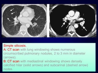 Simple silicosis.
A: CT scan with lung windowing shows numerous
circumscribed pulmonary nodules, 2 to 3 mm in diameter
(arrows).
B: CT scan with mediastinal windowing shows densely
calcified hilar (solid arrows) and subcarinal (dashed arrow)
nodes.
 