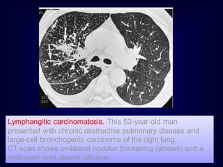 Lymphangitic carcinomatosis. This 53-year-old man
presented with chronic obstructive pulmonary disease and
large-cell bronchogenic carcinoma of the right lung.
CT scan shows unilateral nodular thickening (arrows) and a
malignant right pleural effusion.
 