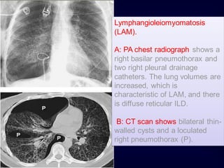 Lymphangioleiomyomatosis
(LAM).
A: PA chest radiograph shows a
right basilar pneumothorax and
two right pleural drainage
catheters. The lung volumes are
increased, which is
characteristic of LAM, and there
is diffuse reticular ILD.
B: CT scan shows bilateral thin-
walled cysts and a loculated
right pneumothorax (P).
 