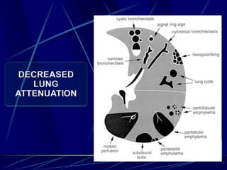 DECREASED
LUNG
ATTENUATION
 
