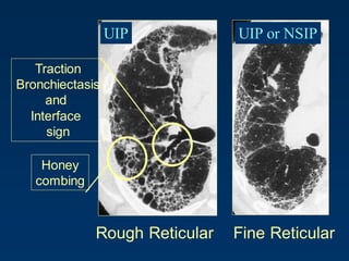 Rough Reticular Fine Reticular
Traction
Bronchiectasis
and
Interface
sign
Honey
combing
UIP UIP or NSIP
 