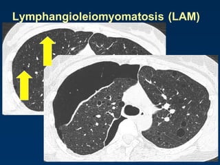 Lymphangioleiomyomatosis (LAM)
 