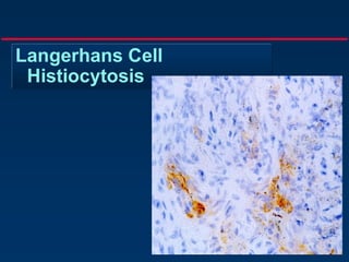 Langerhans Cell
Histiocytosis
 