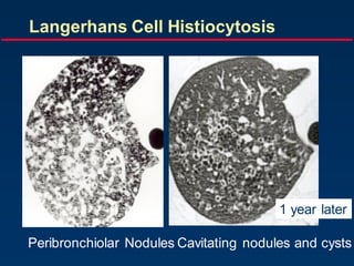 1 year later
Peribronchiolar Nodules Cavitating nodules and cysts
Langerhans Cell Histiocytosis
 